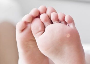 Бородавки потрібно видаляти