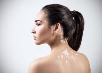 25 червня – Всесвітній день вітиліго. Людям із вітиліго засмагати не варто