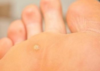 Стрижневого мозоля потрібно позбутися