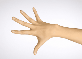 Дизгідроз або дизгідротична екзема