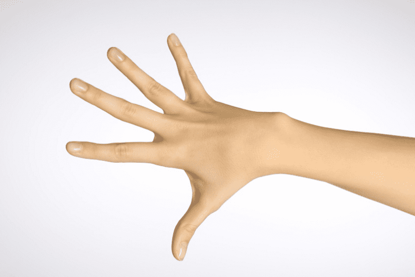 Дизгідроз або дизгідротична екзема