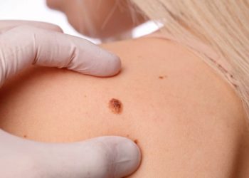 Чи небезпечні себорейні кератоми