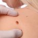 Чи небезпечні себорейні кератоми