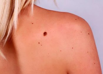 Рання діагностика меланоми рятує життя