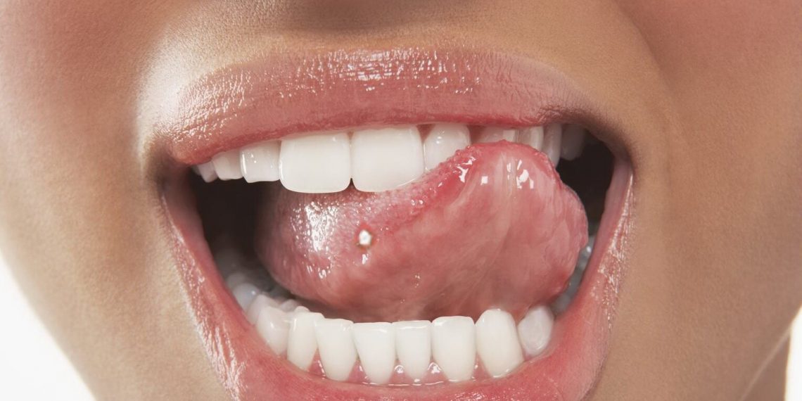 Чому язик запалюється?