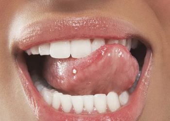 Чому язик запалюється?