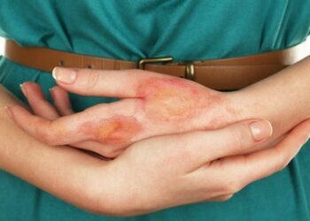 Домедична допомога у разі опіків: що потрібно знати?