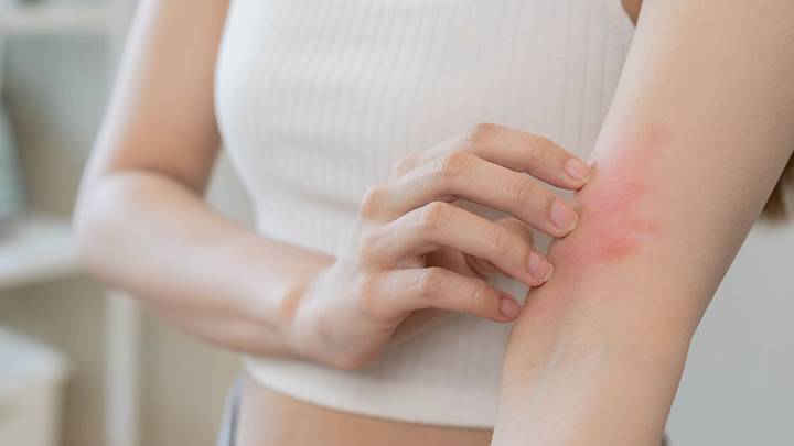 Як заспокоїти шкіру від алергії?
