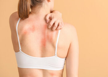 Кропив’янка: як вилікувати алергічний дерматит