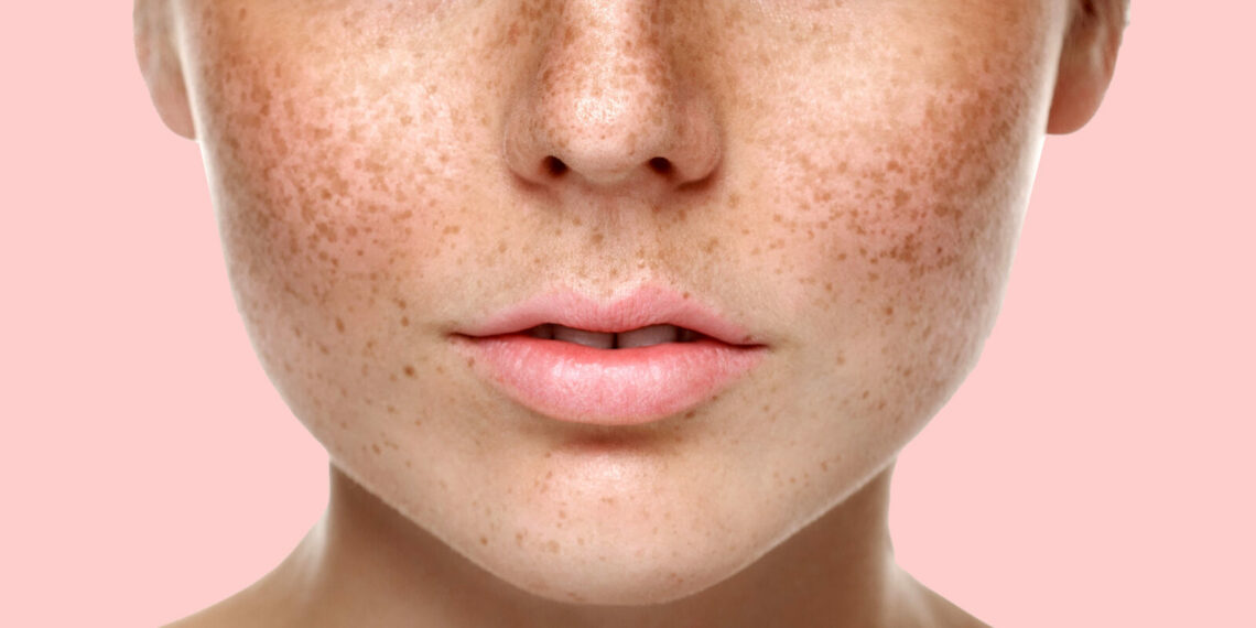 Чому з’являються пігментні плями?