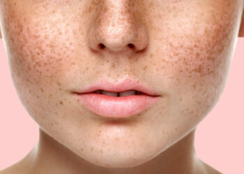 Чому з’являються пігментні плями?