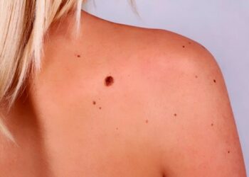 Небезпечна меланома: як захистити себе від цієї проблеми