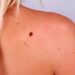 Небезпечна меланома: як захистити себе від цієї проблеми