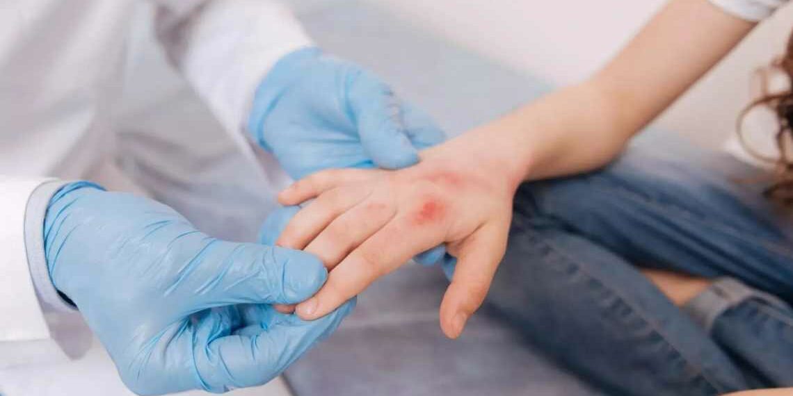 Піодермія: як повернути здоров’я шкіри