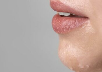 Сухість у роті: в чому причина й чим загрожує