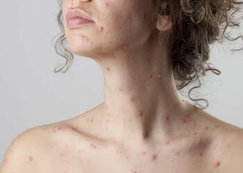 Чи варто довіряти свою шкіру «синьці» та фукорцину