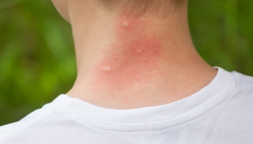 Чи всі укуси комах потрібно лікувати?