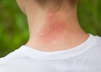 Чи всі укуси комах потрібно лікувати?